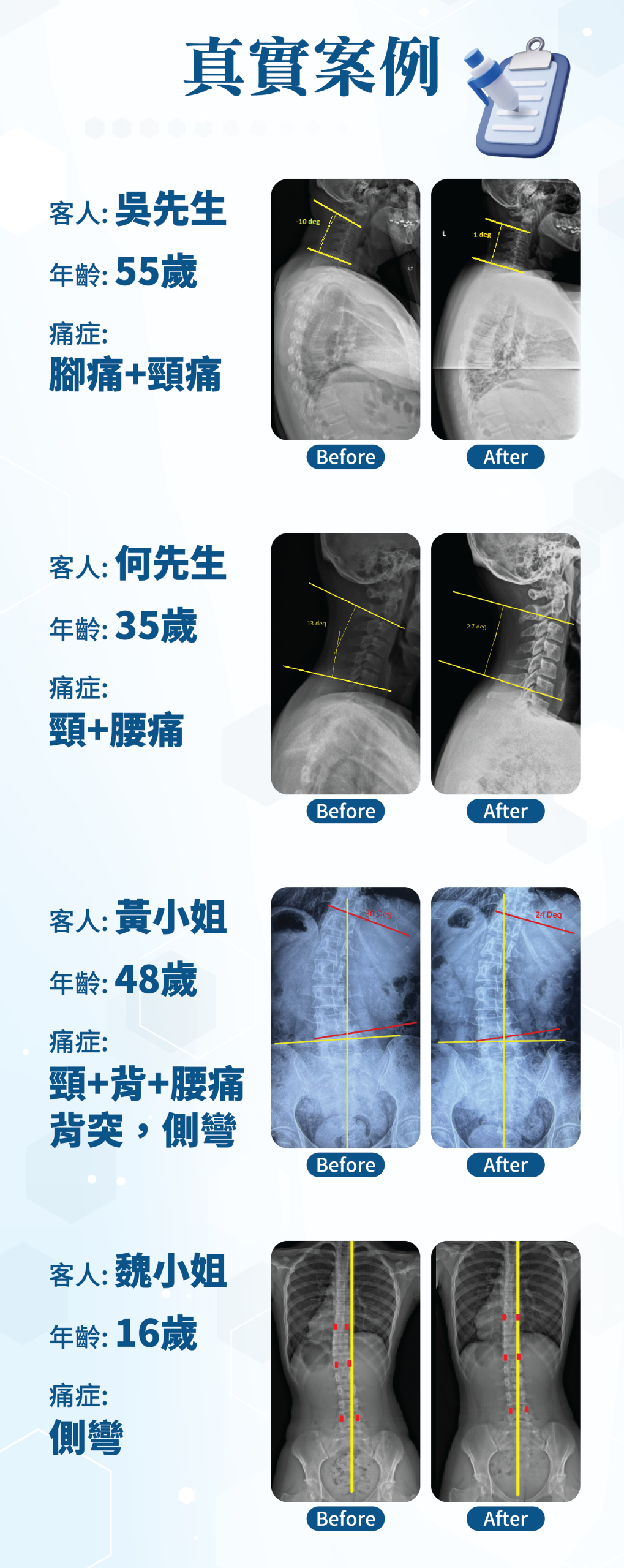 真實案例 客人：吳先生 年齡：55歲 痛症：腳痛＋頸痛 Before / After 客人：何先生 年齡：35歲 痛症：頸＋腰痛 Before / After 客人：黃小姐 年齡：48歲 痛症：頸＋背＋腰痛 肩、笑、側彎 Before / After 客人：魏小姐 年齡：16歲 痛症：側彎 Before / After